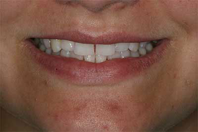 Cosmetic Dentist in Jamesville NY